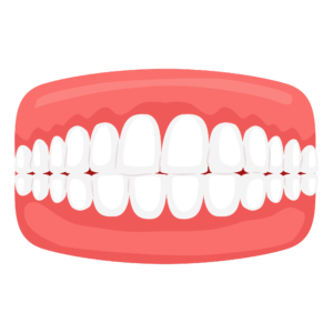 Dental misalignment issue - crossbite - clearalignertreatmentinkerala.com
