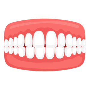 Dental Misalignment Issues - Spacing - clearalignerinkerala.com