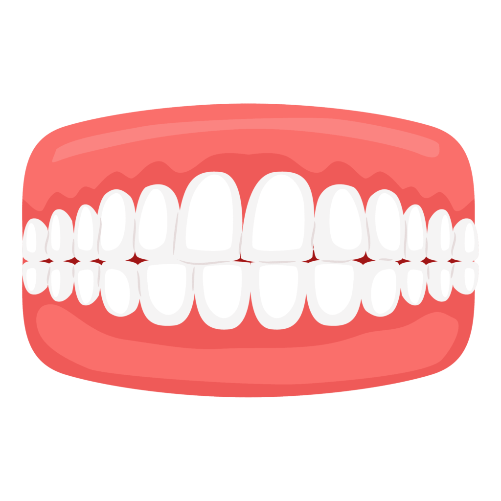 Crossbite - Illustration of crossbite showing misaligned upper and lower teeth.