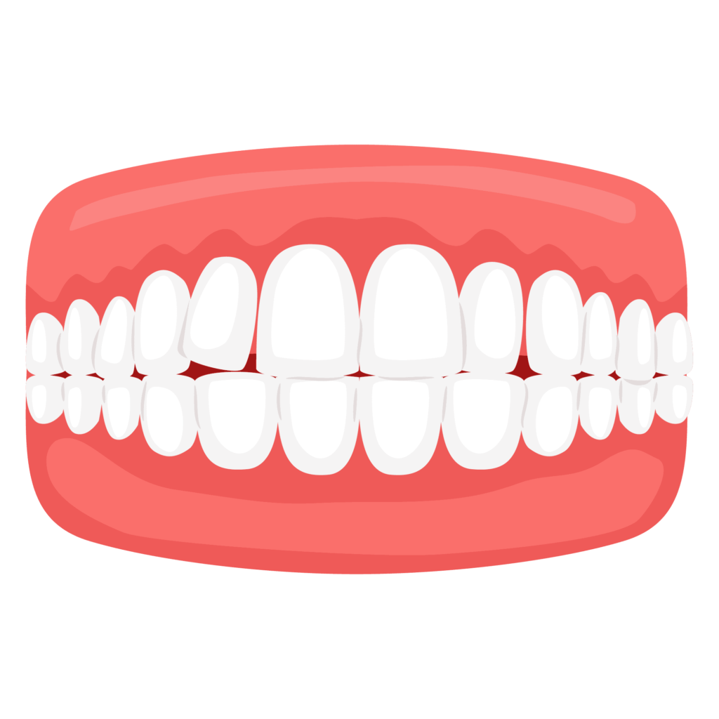Crowded Teeth - Illustration of crowded teeth with overlapping and misaligned teeth.