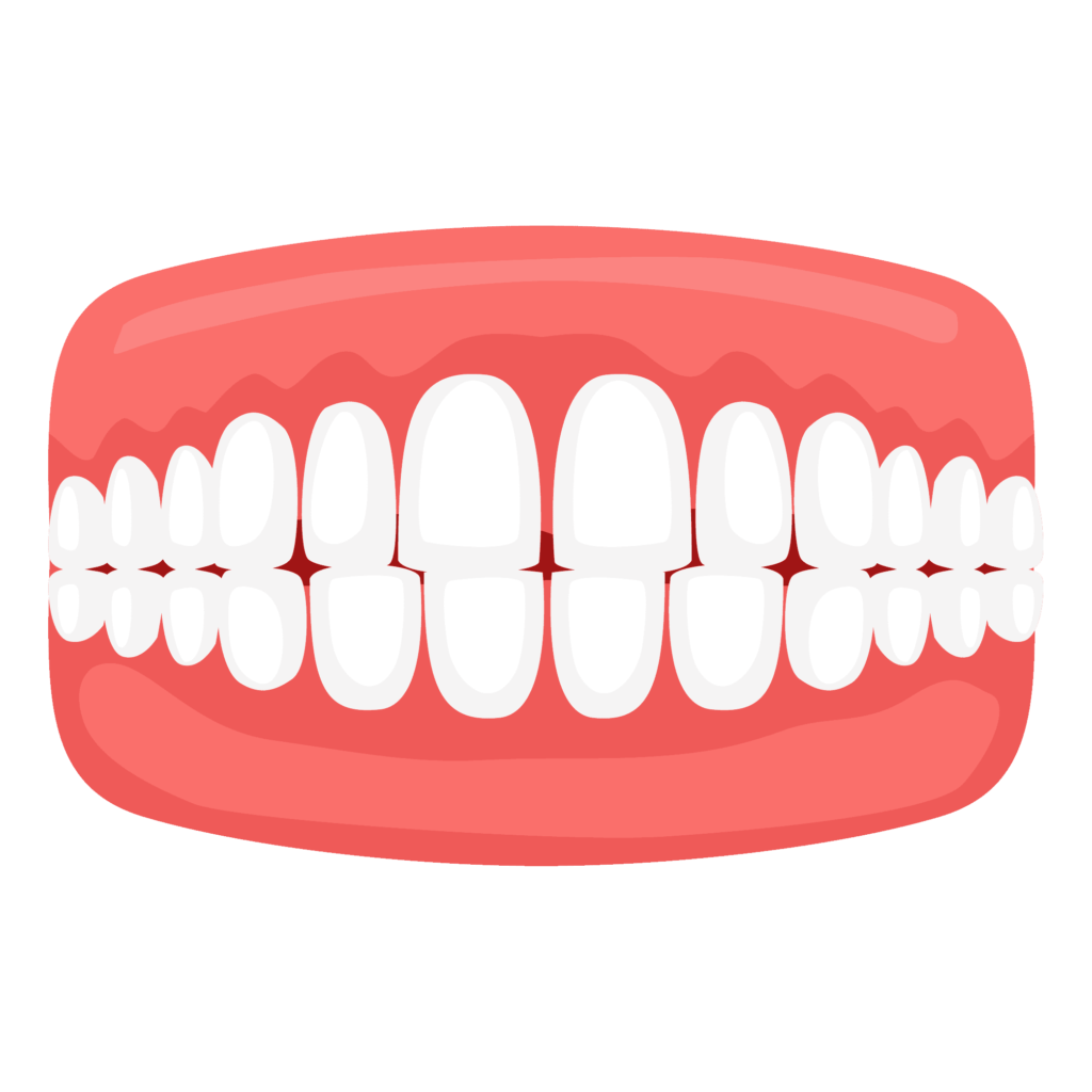 Gapped Teeth - Dental Problems Clear Aligners Can Fix - Illustration of gapped teeth showing spaces between upper front teeth.