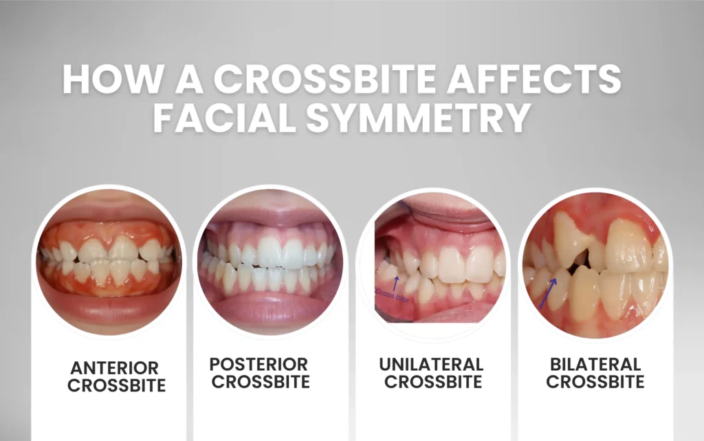 How a Crossbite Affects Facial Symmetry, Jawline & Smile