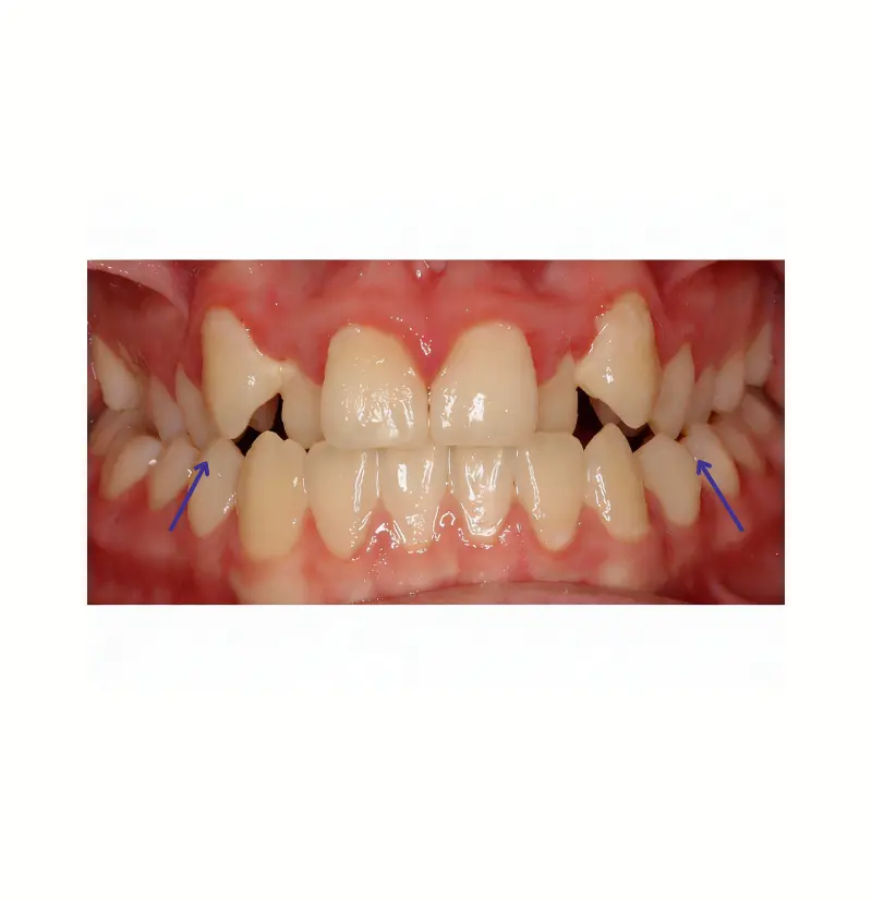 Bilateral Crossbite