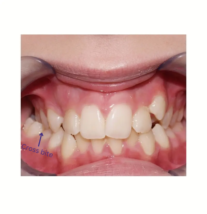Posterior Crossbite