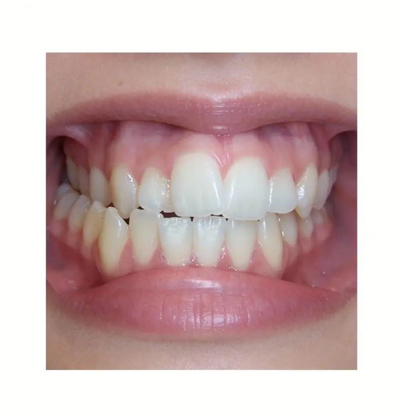 Unilateral Crossbite