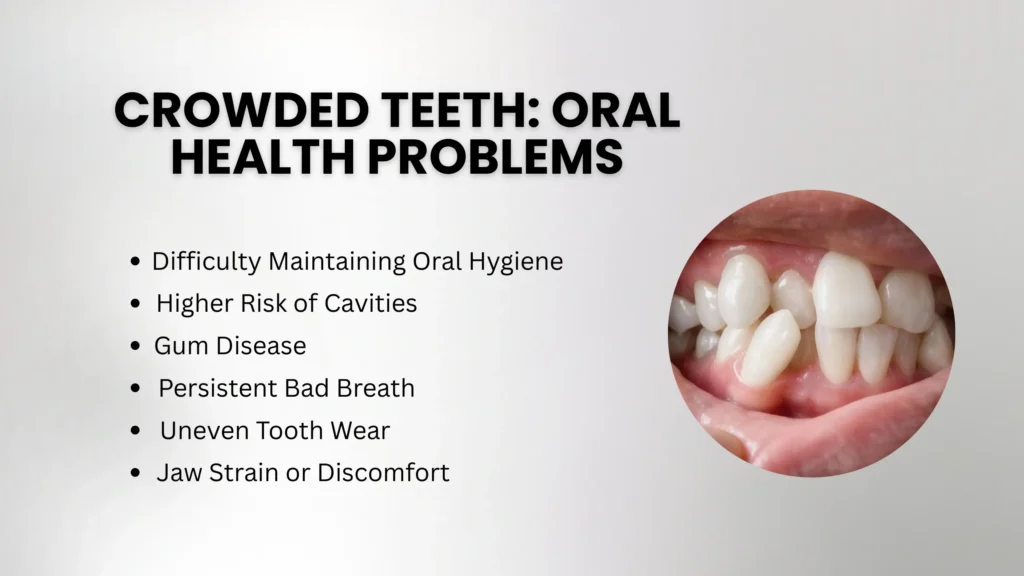 Crowded Teeth: Causes, Oral Health Problems & Treatment Methods